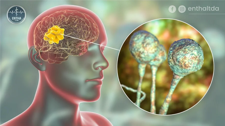 5 Datos Curiosos sobre la Mucormicosis