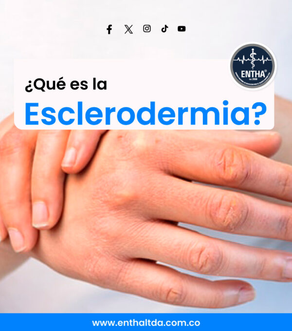 ¿Qué es la Esclerodermia?