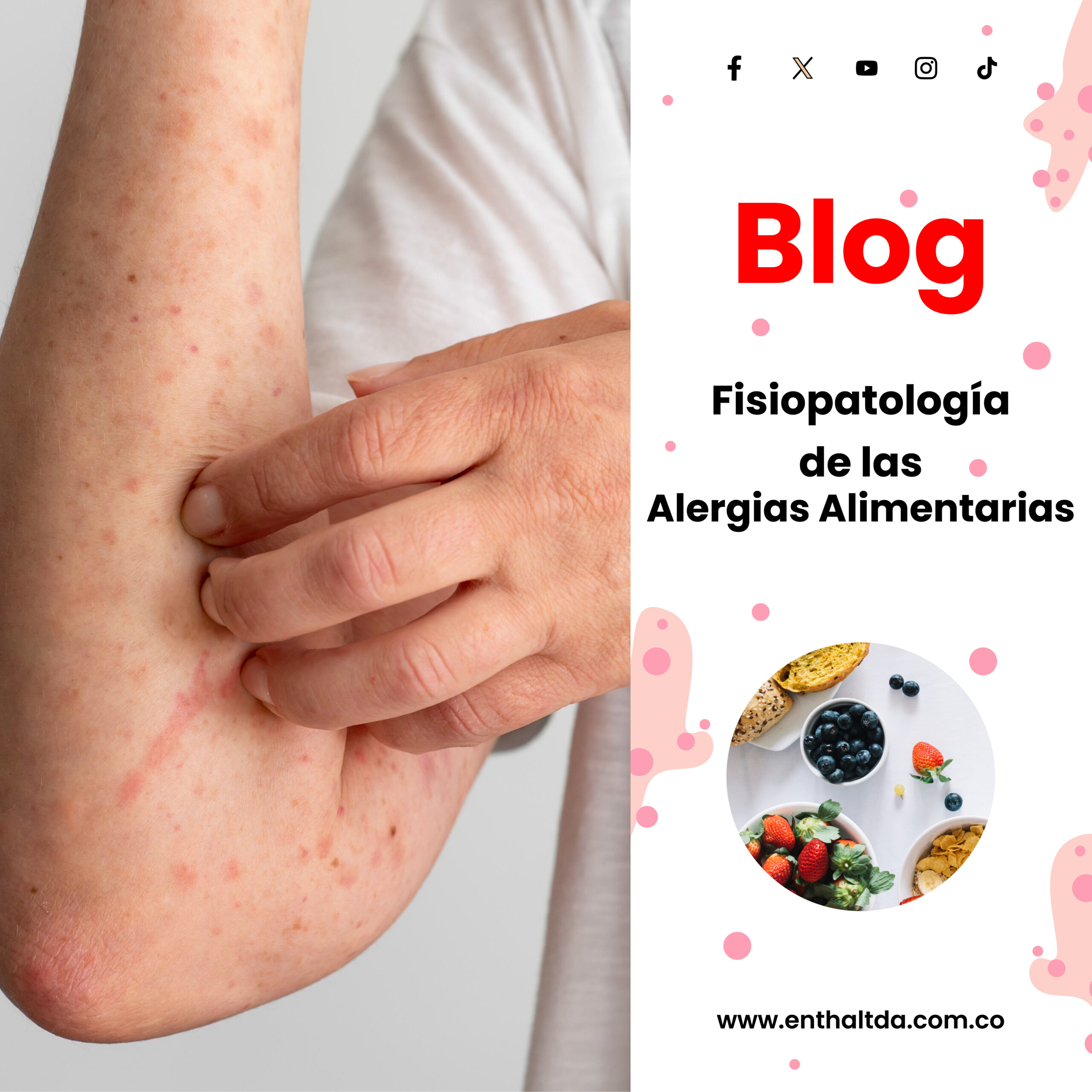 Fisiopatología de las Alergias Alimentarias