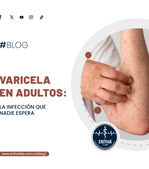 Varicela en Adultos: La Infección que Nadie Espera