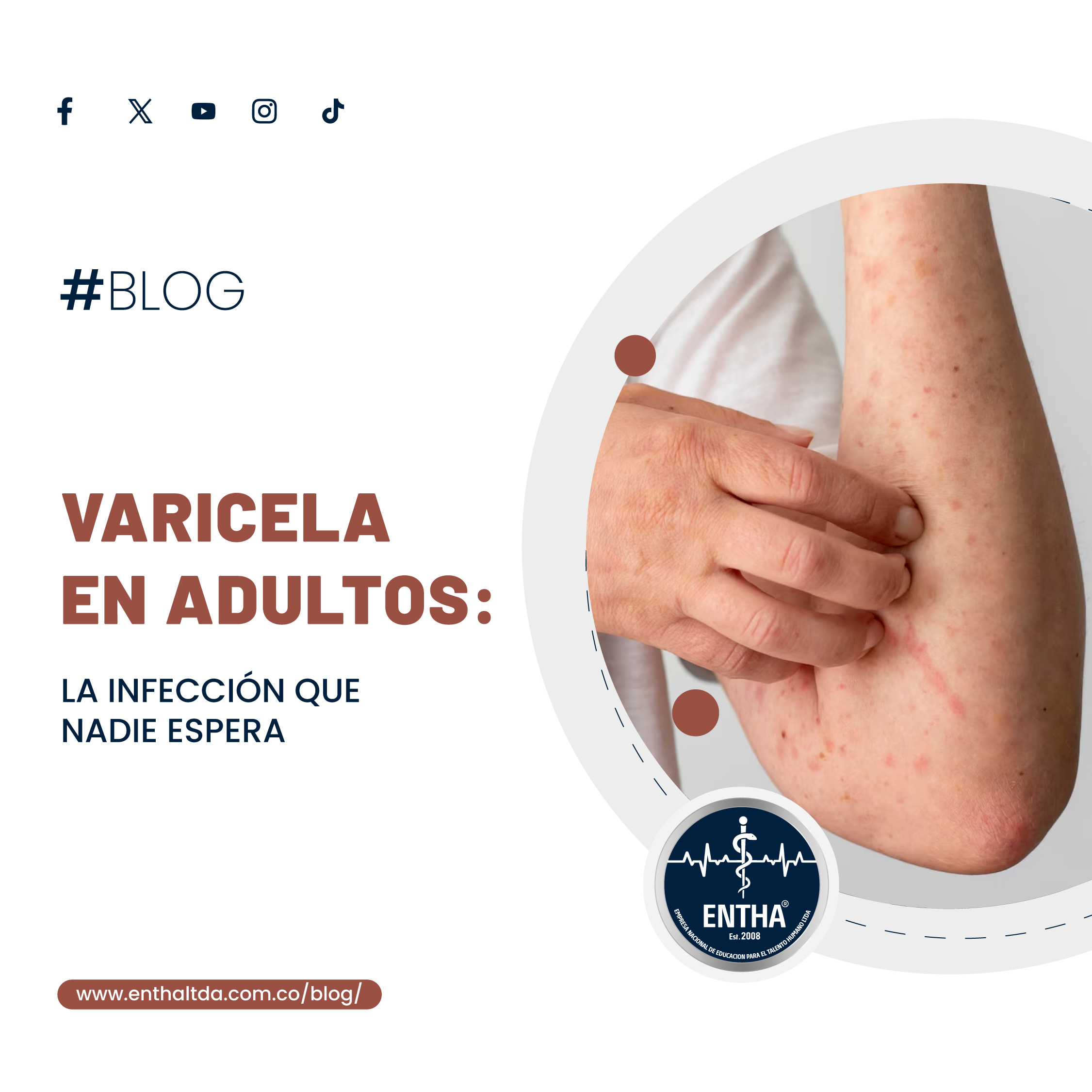 Varicela en Adultos: La Infección que Nadie Espera