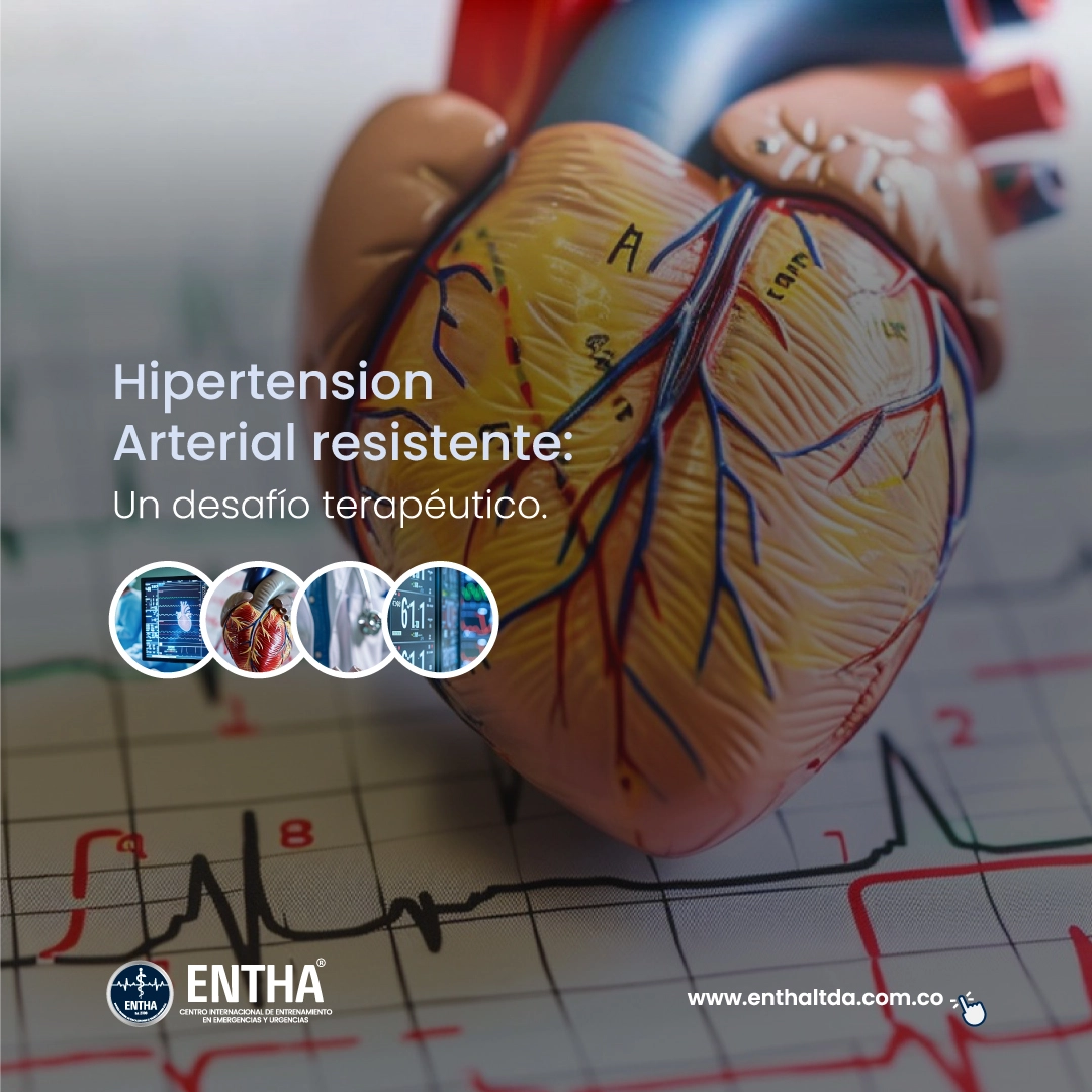 Hipertensión arterial resistente: Un desafío terapéutico