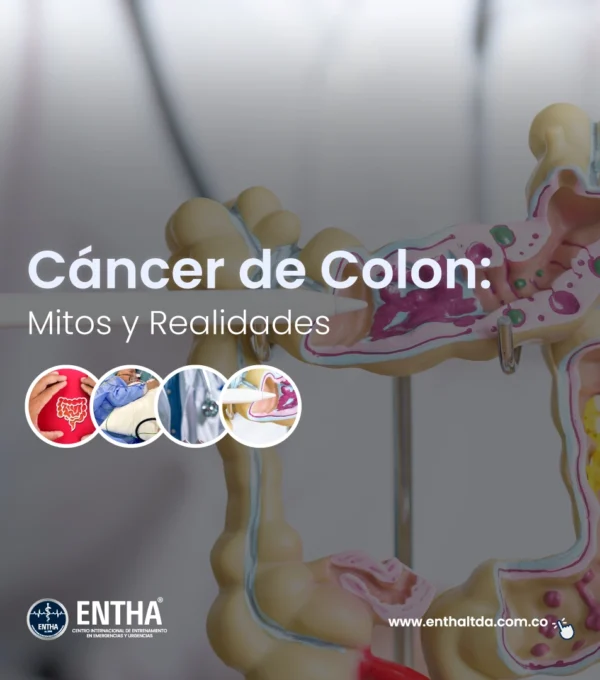 Cáncer de colon: mitos y realidades