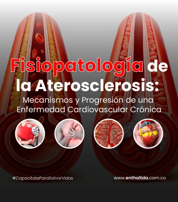 Fisiopatología de la Aterosclerosis: Mecanismos y Progresión de una Enfermedad Cardiovascular Crónica