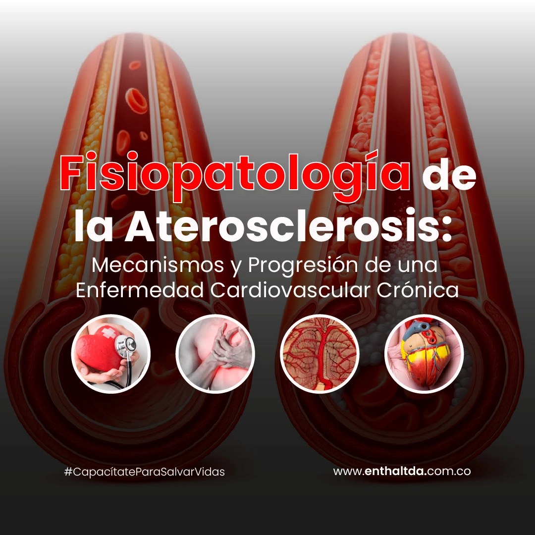 Fisiopatología de la Aterosclerosis: Mecanismos y Progresión de una Enfermedad Cardiovascular Crónica