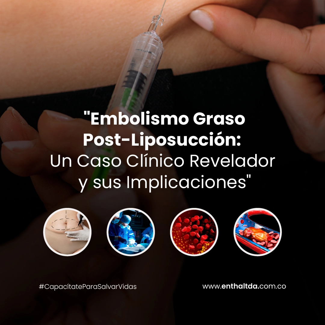 Embolismo Graso Post-Liposucción: Un Caso Clínico Revelador y sus Implicaciones