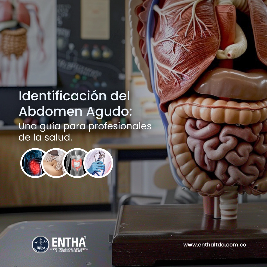 Identificación del Abdomen Agudo: Una Guía para Profesionales de la Salud